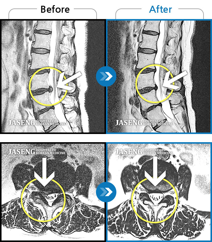 대구자생한방병원 치료사례 MRI로 보는 치료결과-누워서 잘 때나 서 있을 때 통증, 우측 골반 허벅지 통증