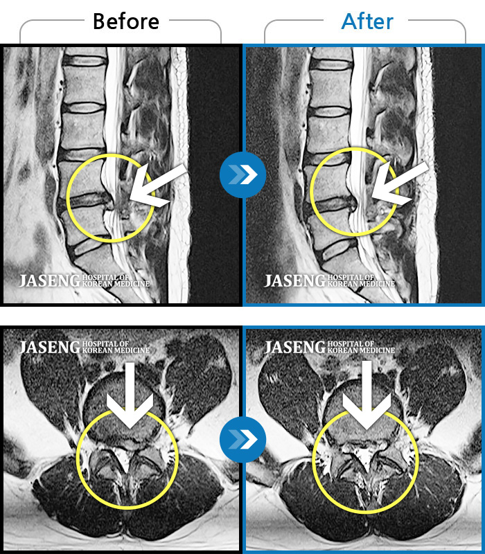 대구자생한방병원 치료사례 MRI로 보는 치료결과-어떠한 자세를 취해도 통증이 있고 왼쪽 엉덩이, 다리 통증으로 잠을 자주 깬다.
