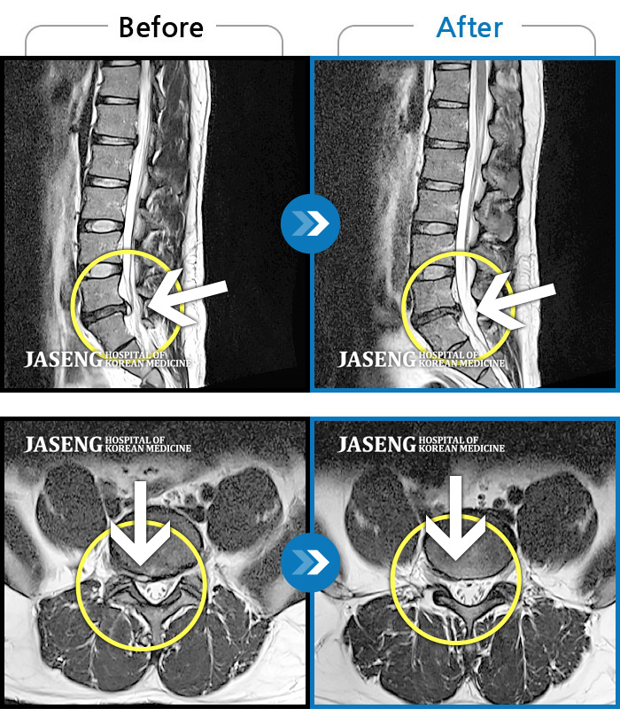 대구자생한방병원 치료사례 MRI로 보는 치료결과-앉거나 걷거나 심지어 가만히 있을 때에도 항상 허리와 다리가 너무나도 저리고 아팠다.
