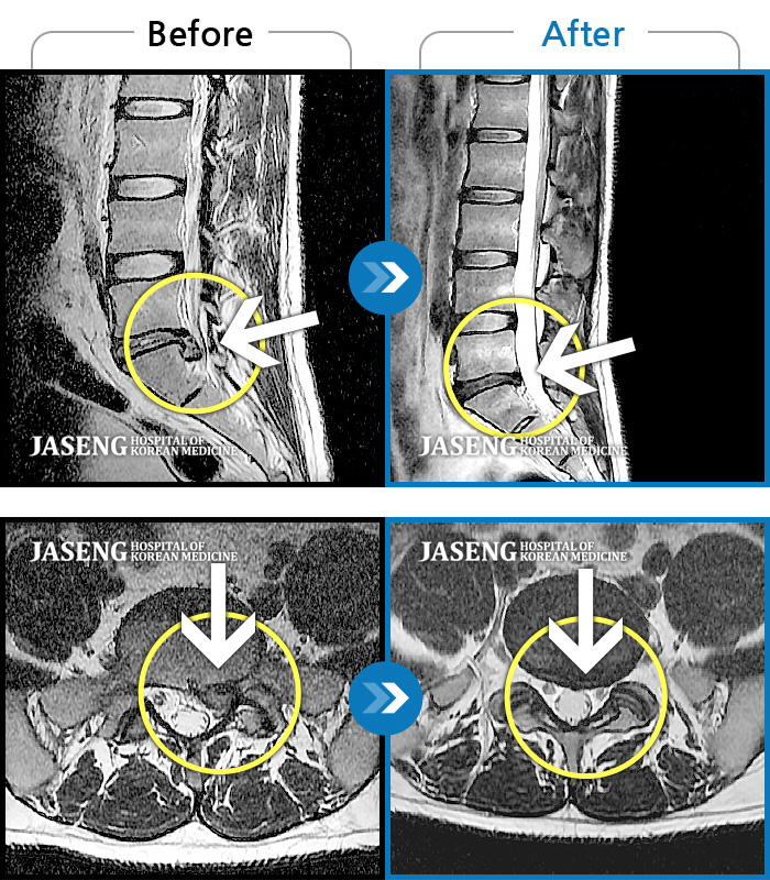 대구자생한방병원 치료사례 MRI로 보는 치료결과-요부 통증 및 좌측 하지 통증이 심해서 걸을 수가 없다.