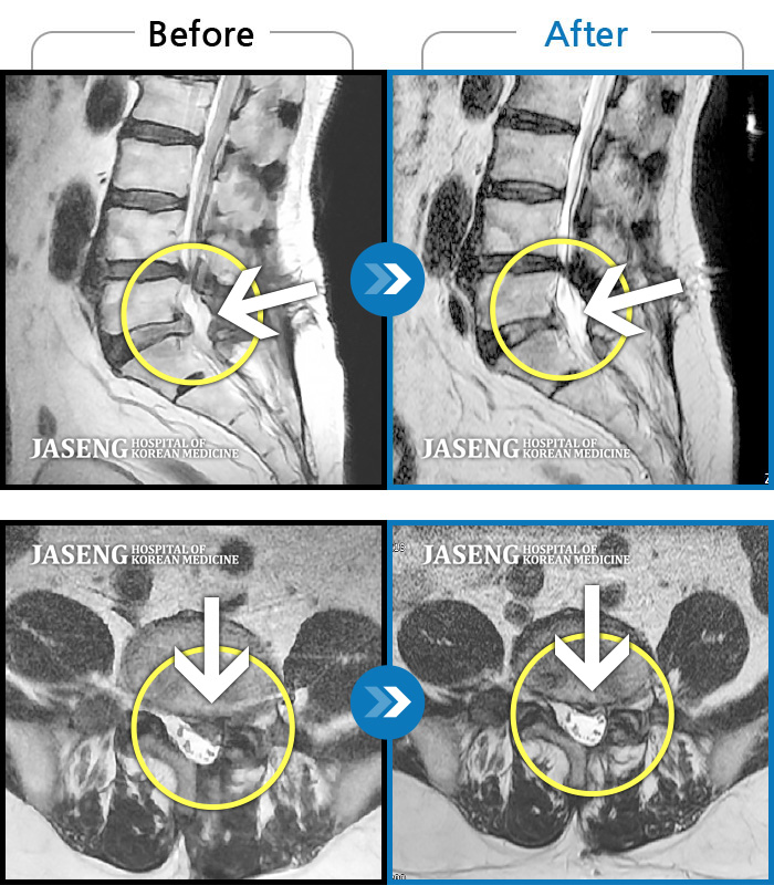 대구자생한방병원 치료사례 MRI로 보는 치료결과-허리가 욱신욱신하게 아프고 보행 시 왼쪽 골반, 허벅지, 종아리가 당겨서 걷기 어려움