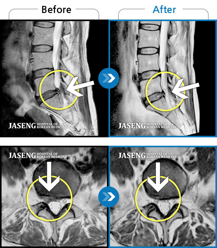 대구자생한방병원 치료사례 MRI로 보는 치료결과-오른쪽 골반, 허벅지, 종아리가 당겨서 걷기 어려움