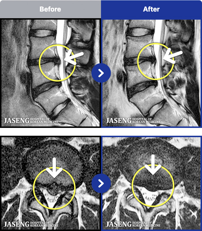 �ڻ��ѹ溴�� ġ���� MRI�� ���� ġ����-��ð� �ɾ� �ִ� ��Ȱ�� �����ϴ� �� ���� ������ ������ ����� �������� ���� ������ �߻�
