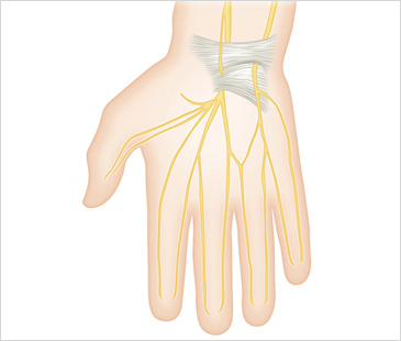 대구자생한방병원 기타관절질환 손목터널증후군-손목터널증후군에 관련된 이미지 입니다.
