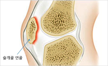 대구자생한방병원 무릎질환 슬개골연골연화증-슬개골 연골이 위치해 있는 무릎 설명 이미지