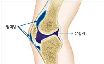 대구자생한방병원 무릎질환 무릎점액낭염-점액낭과 윤활액이 위치해 있는 무릎 설명 이미지