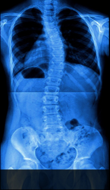 대구자생한방병원 허리질환 척추측만증-척추측만증에 관련된 이미지 입니다.