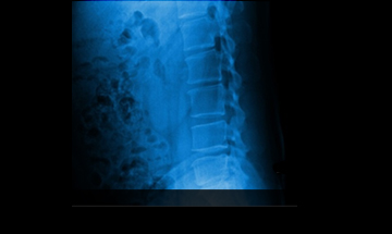 대구자생한방병원 허리질환 척추후만증-척추후만증에 관련된 이미지 입니다.