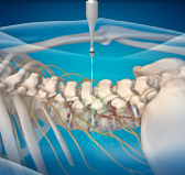 대구자생한방병원 허리치료법 신경근회복술-신경근회복술의 특징 두번째 관련 사진 입니다.