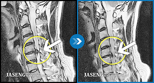 목과 왼쪽 팔부위에 야간통이 심한 경우의 MRI 사진