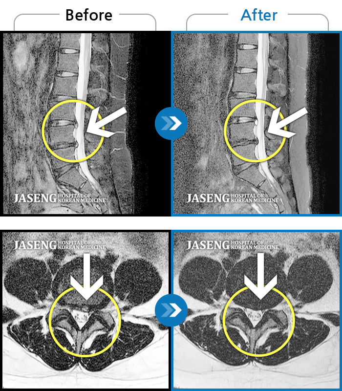 자생한방병원 치료사례 MRI로 보는 치료결과-허리 양쪽과 골반, 양측 다리까지 다 아파요