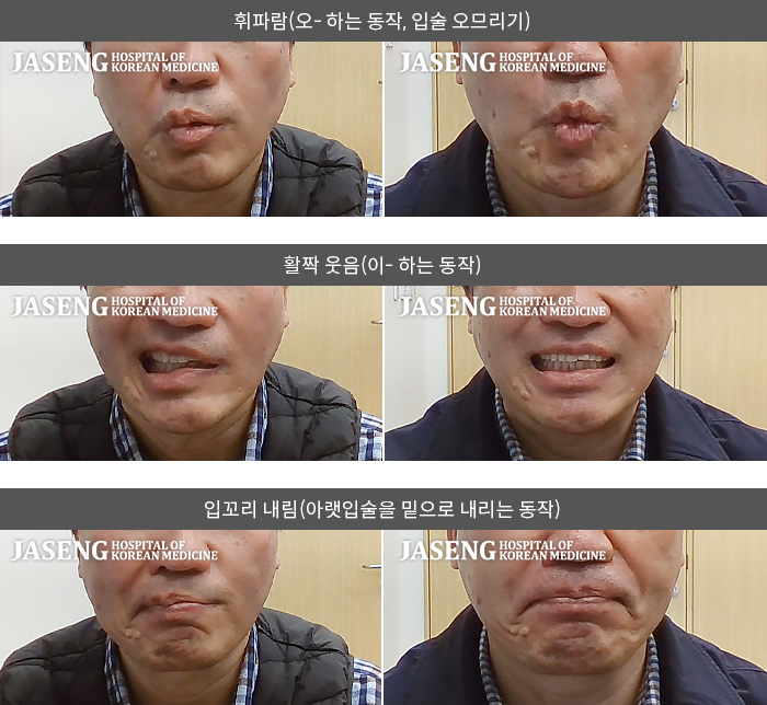 자생한방병원_안면신경마비 치료 전후 사례