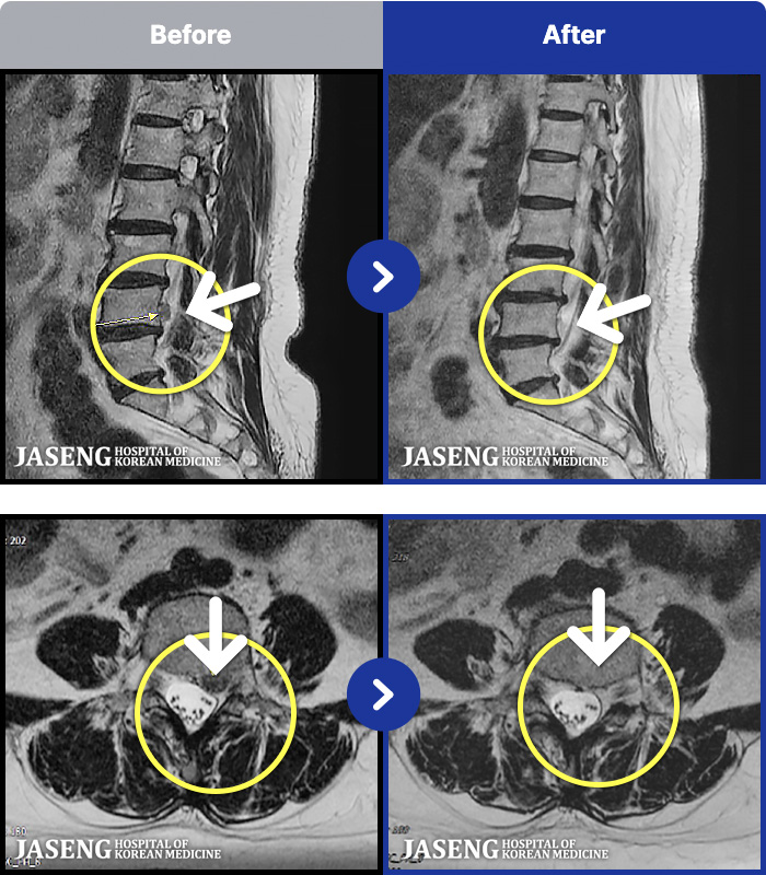 인천자생한방병원 MRI 치료 전후 사례