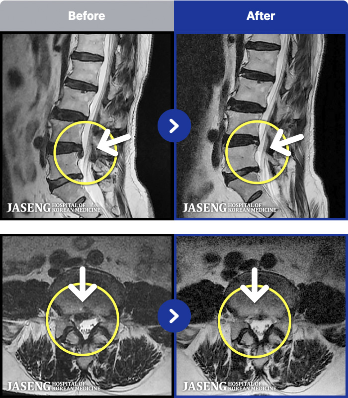 해운대자생한방병원 MRI 치료 전후 사례