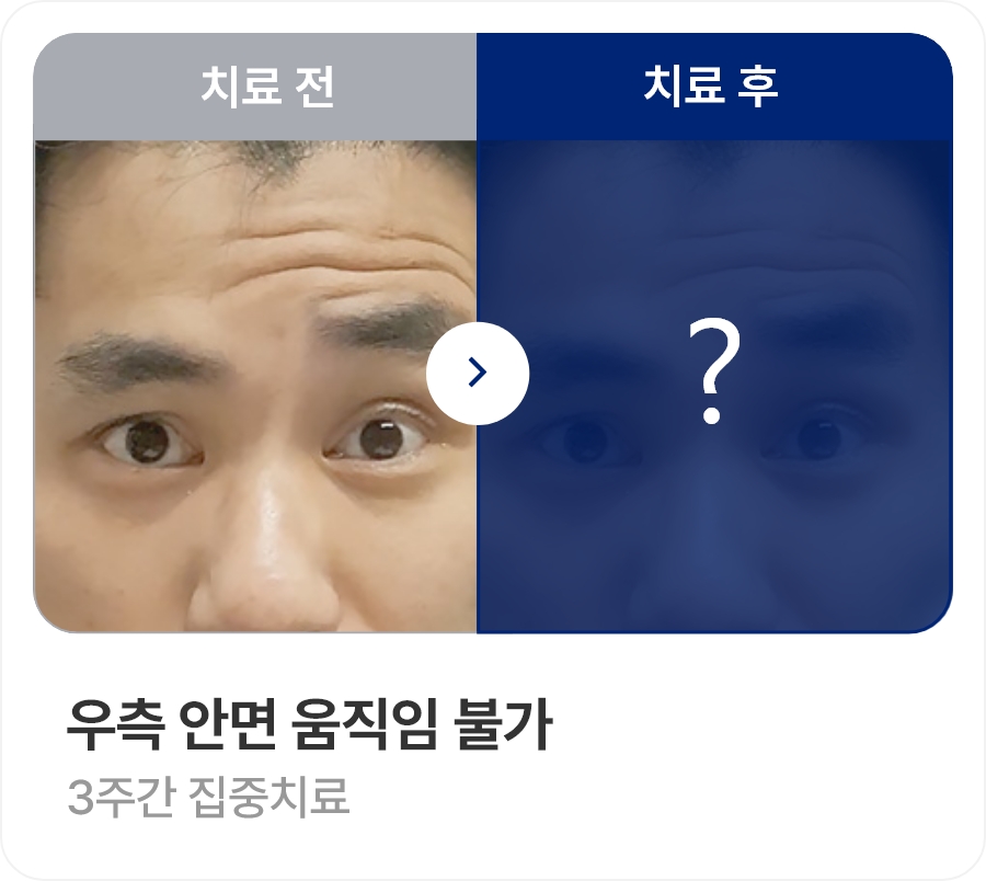 우측 안면 움직임 불가 / 3주간 집중치료