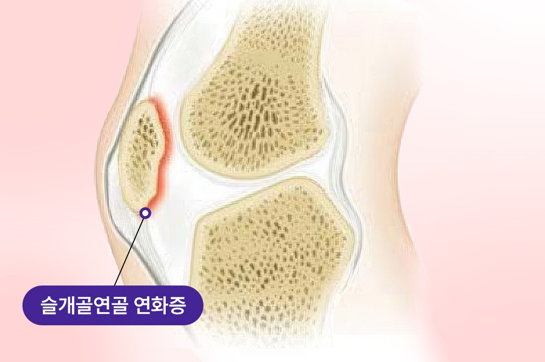 무릎 관절 연골이 연화된 부위를 표시한 일러스트