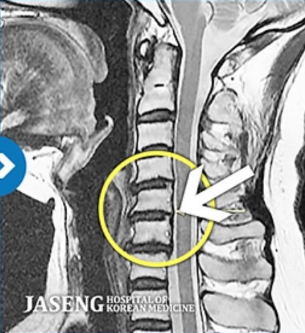 자생 비수술 한방통합치료 후 MRI 비교 이미지