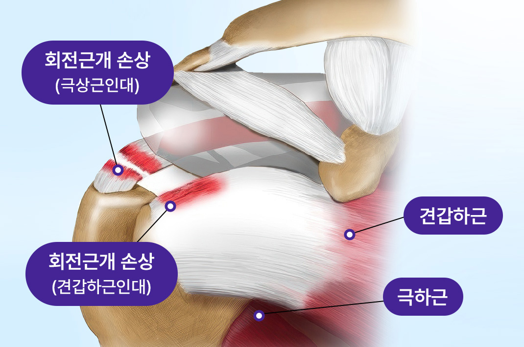 어깨 회전근개 힘줄이 손상된 부위를 표시한 일러스트