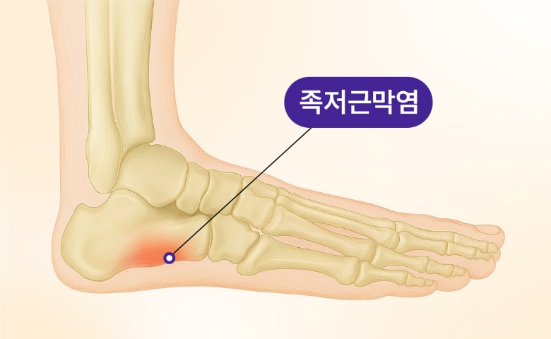 족저근막염에 걸린 발 일러스트
