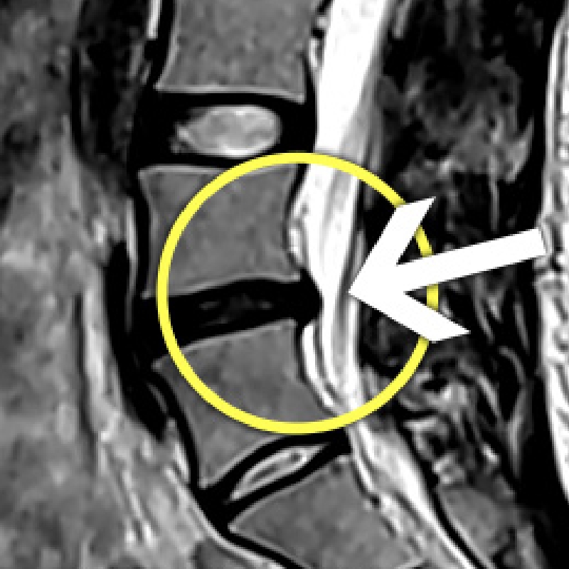 허리 MRI 영상에서 문제 부위를 노란 원과 화살표로 표시한 이미지
