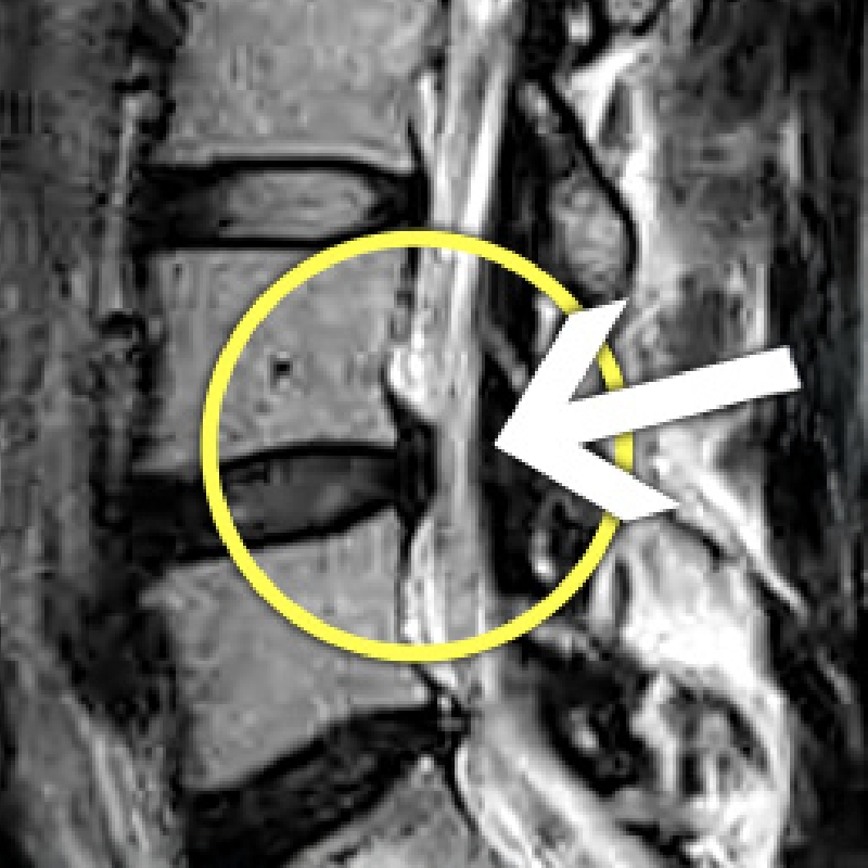 허리 MRI 영상에서 문제 부위를 노란 원과 화살표로 표시한 이미지